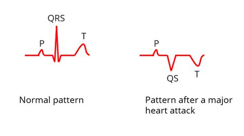 Simplified Explanation Of Ecg Changes In A Heart Attack All About