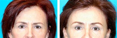 Forehead Lift Scottsdale Brow Lift Cosmetic Surgery