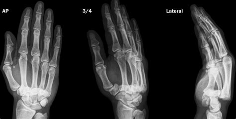 Carpometacarpal Joint Dislocation