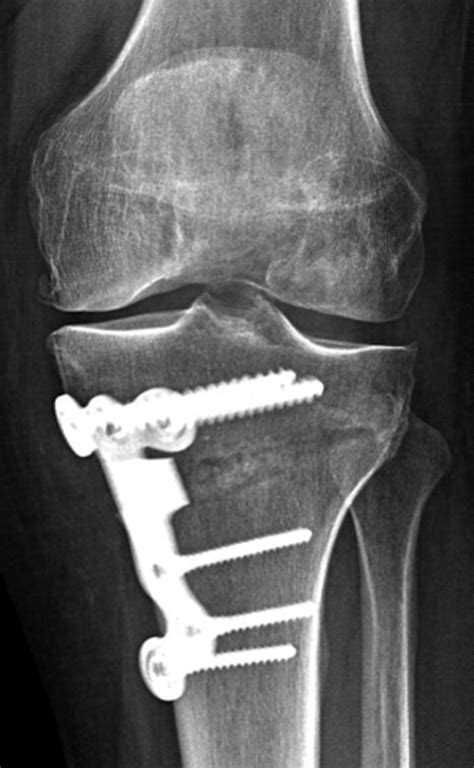 High Tibial Osteotomy An Update For Radiologists Ajr