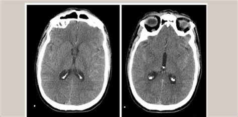 Diffuse Subarachnoid Hemorrhage In The Bilateral Posterior Frontal