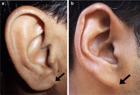 Ear Lobe Attached