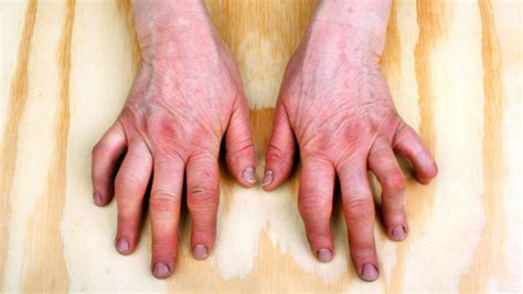 81 Rheumatoid Arthritis Symptoms Knee What Is Arthritis Of The Hands