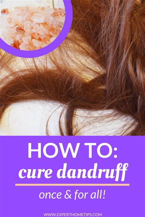 How To Get Rid Of Dandruff Faster Than You Ever Thought Possible