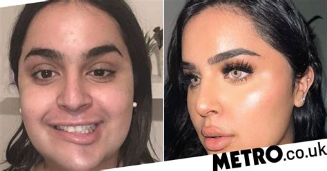 Woman Left With Wonky Face After Botched Fat Dissolving Injections