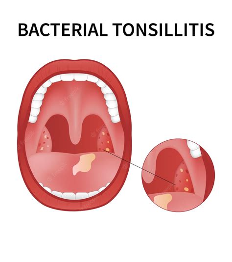 Premium Vector Bacterial And Viral Tonsillitis Angina Pharyngitis And