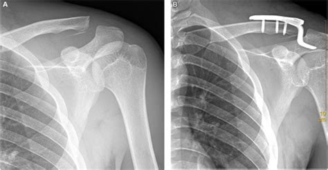 Treatment Of Coracoid Process Fractures Combined With Acromioclavicular