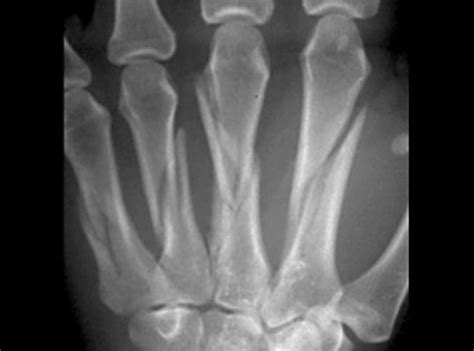 Metacarpal Fractures Hand Orthobullets