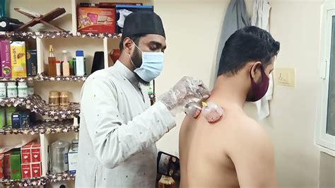 Hijama Wet Cupping Sunnah Points YouTube
