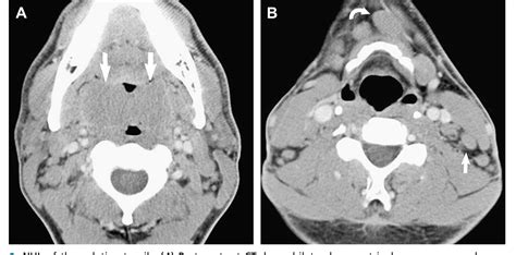 Imaging Hodgkin And Non Hodgkin Lymphoma In The Head And Neck