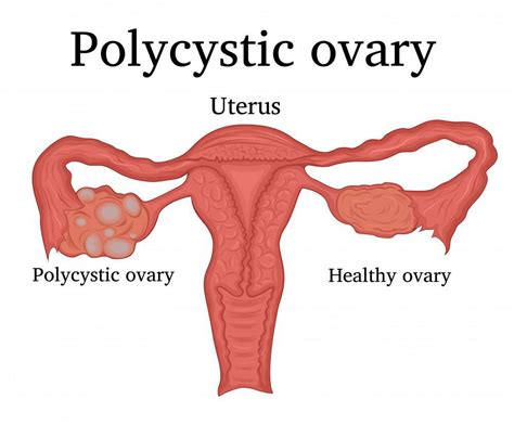 Polycystic Ovarian Syndrome Mcdowell Mountain Gynecology General Gynecology Minimally
