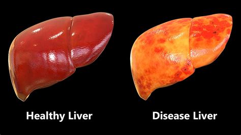 Nonalcoholic Fatty Liver Disease Are You Taking Care Of Your Liver