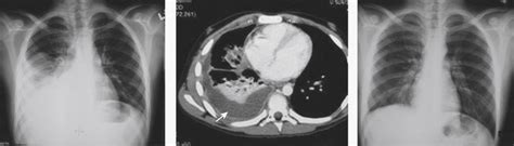 Thoracoscopic Decortication And Debridement For Empyema Abdominal Key