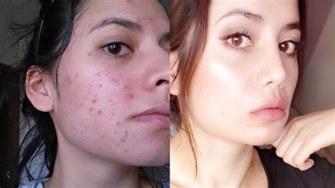 Tretinoin Before And After 12 Tips To Get The Best Results Youtube
