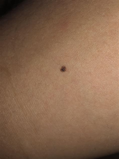 Theres A Black Dot In This Freckle Is It Normal Rdermatology