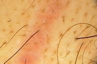 Lipedematous alopecia of the scalp
