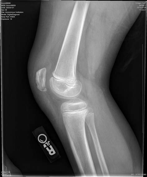 Patellar Sleeve Fracture With Ossification Of The Patellar Tendon My