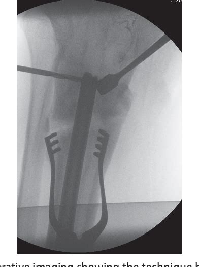 Figure 6 From A Novel Surgical Technique For Extraction Of A Firmly