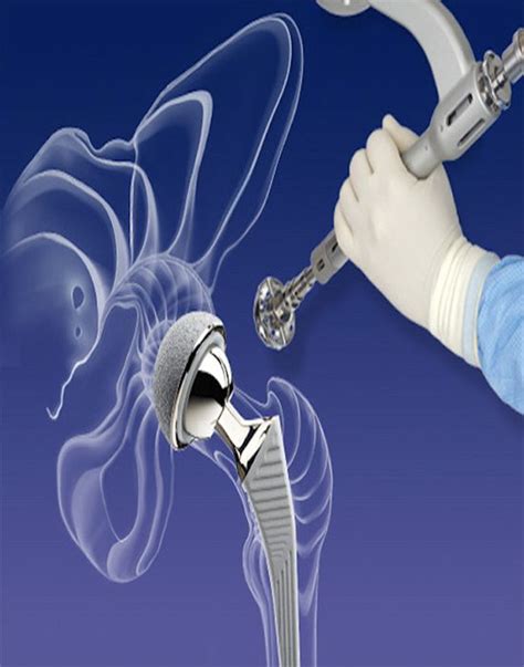 Mako Robotic Hip Replacement Dr Alevrogiannis2107786868