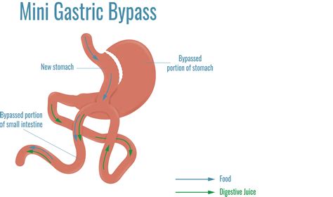 All You Need To Know About Mini Gastric Bypass Dr Ceyhun Aydoğan