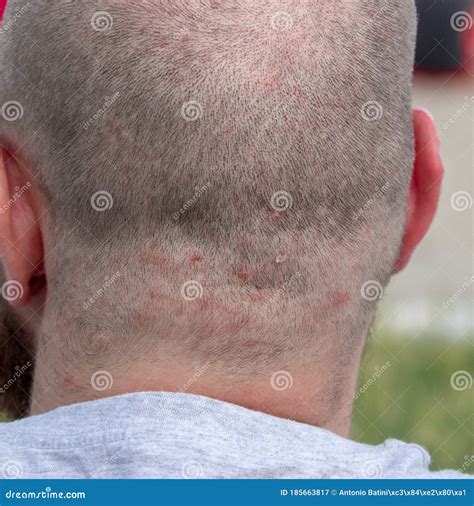 Back Of The Head Of A Short Haired Man Suffering From Scalp Acne