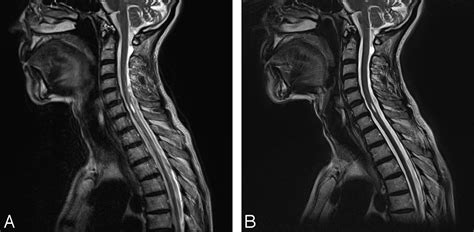 Blade In Sagittal T Weighted Mr Imaging Of The Cervical Spine American Journal Of Neuroradiology