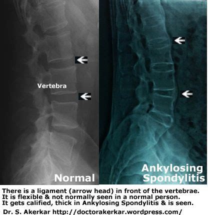 spondylitis ankylosing spine ray normal vs arthritis rays psoriatic xray does bamboo progression disease radiology findings autoimmune rate track progress