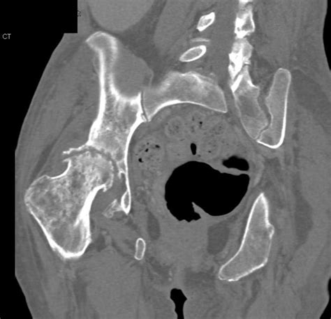 Left Iliopsoas Abscess With Extension To Left Hip Joint