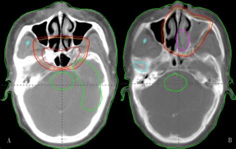 Intensity Modulated Radiotherapy Plan For Nasopharyngeal Carcinoma A