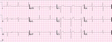 1 online resource (xii, 132 pages) : Dr. Smith's ECG Blog: It is Far too Early for a Requiem ...