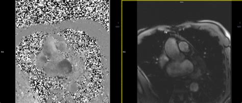 Cardiac Magnetic Resonance Imaging Mri Scan Bangkok H