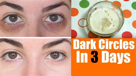 Home Remedies For Dark Circle Under Eyes Remove Dark Circles Dark