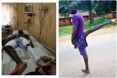 Nigerian Man Whose Leg Was Permanently Suspended In The Air Finally
