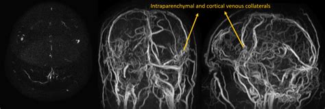 Cureus The Gridlock Between Chronic Cerebral Venous Thrombosis And