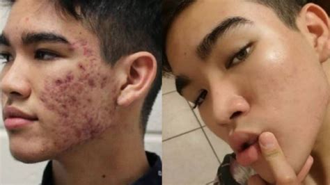 Skincare The 22 Skin Treatment Product That Cured Teen’s Severe Acne