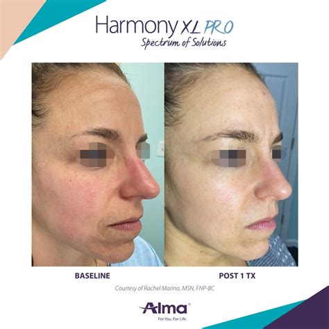 Rosacea Treatment Before And Afters Dermatology