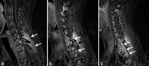 Radiological Imaging Findings Of A Case With Vertebral Osteoid Osteoma