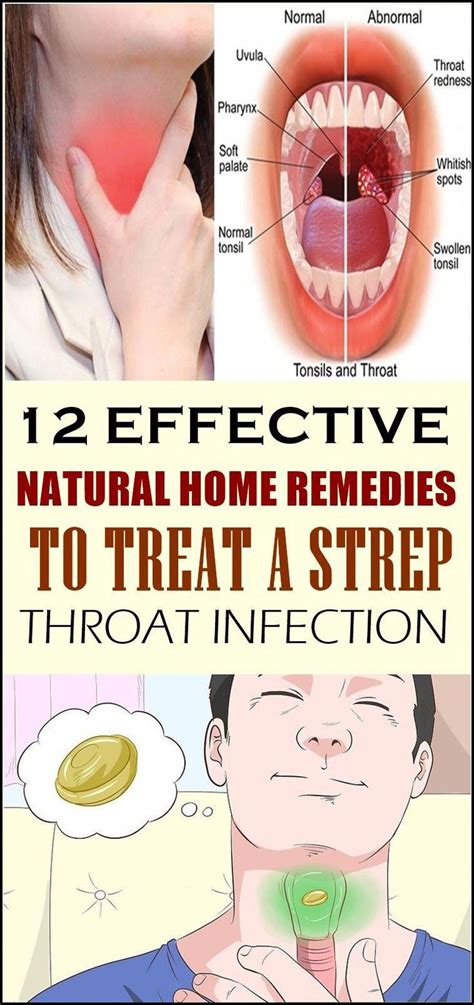 12 Effective Natural Home Remedies To Treat A Strep Throat Infection Naturalacneremedies