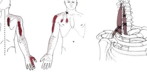What You Need To Know About Muscle Knots Or Trigger Points Healing