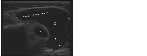 Cystic Hygroma Of The Neck Ultrasound Findings