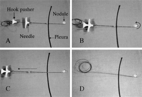 Computed Tomographyguided Localization Of Small Lung Nodules Before