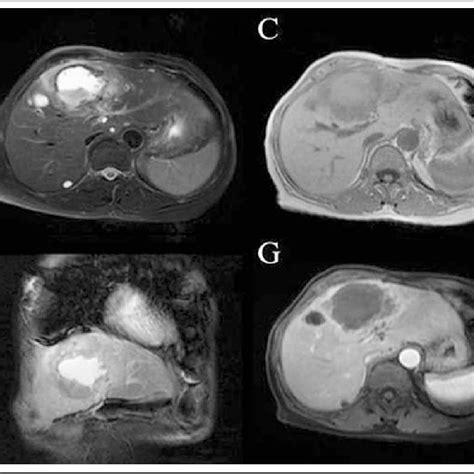 The Different Sequences Of Mri Showing The Hepatic Abscess In The Area