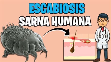 Sarna Humana Escabiosis Sintomas Tratamiento 2023 Sarcoptes Scabiei
