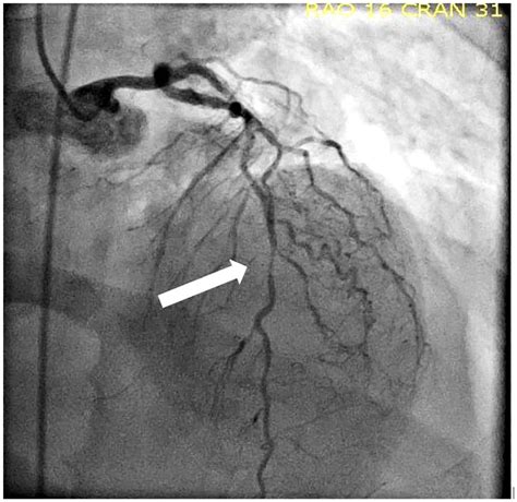 Coexisting Coronary And Carotid Artery Disease Which Technique And In