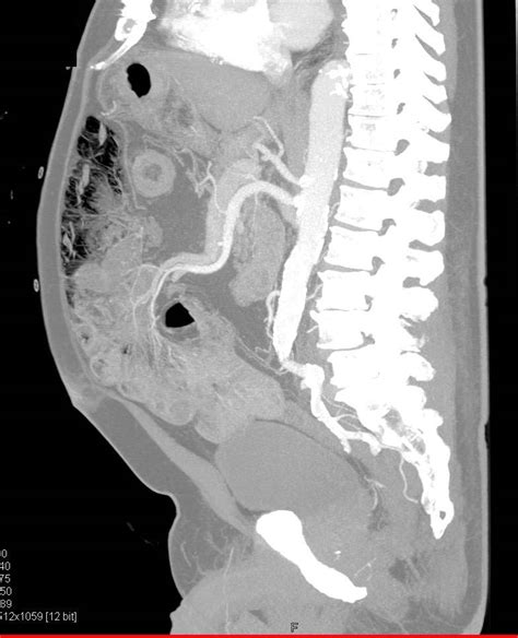 Extensive Pneumatosis Coli With Normal Physical Exam And No Evidence Of