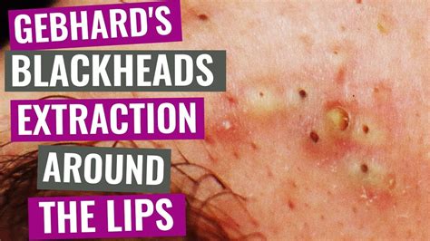 Why Do I Have Blackheads All Around My Lips