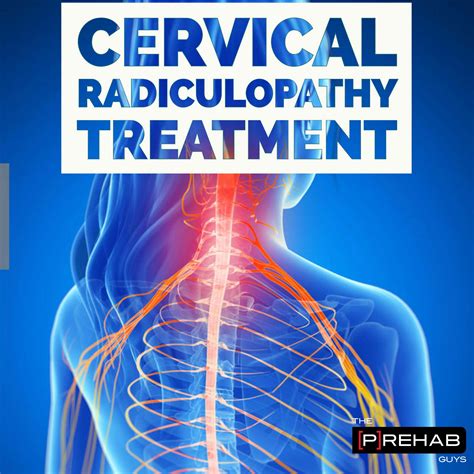 Cervical Radiculopathy Symptoms Treatments Legacy Spi Vrogue Co