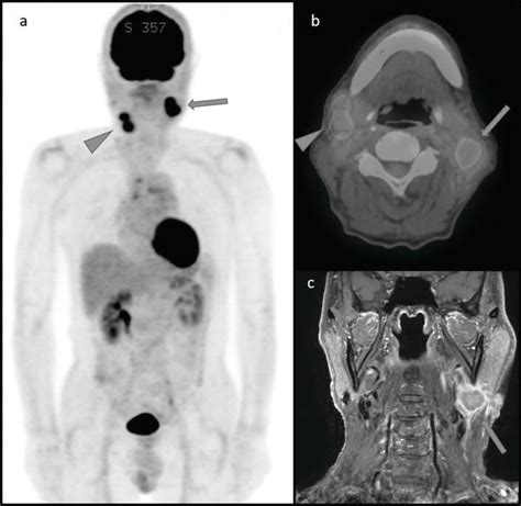 Approach To Diagnosis Of Salivary Gland Disease From Nuclear Medicine