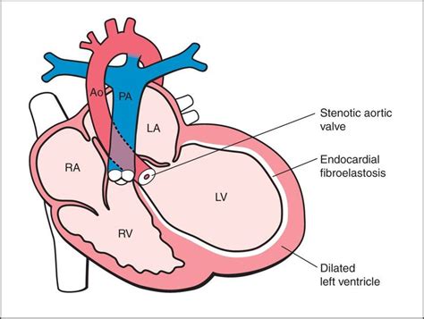Hypoplastic Left Heart Syndrome And Critical Aortic Stenosis Obgyn