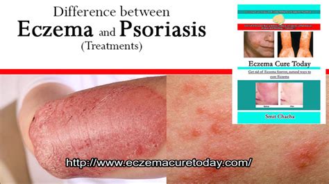 Difference Between Eczema And Psoriasis Skin Condition Youtube
